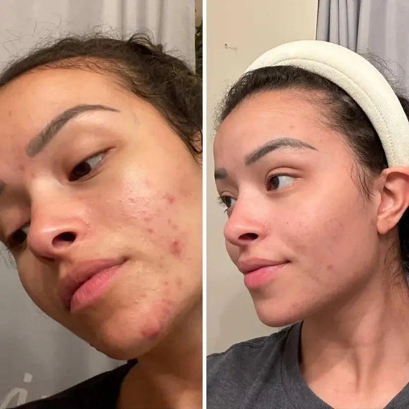 Evatasha | Clarifying Serum (For Acne Prone Skin) - Essentiallydestinyy