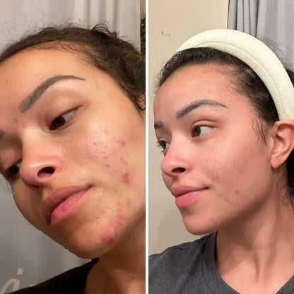 Evatasha | Clarifying Serum (For Acne Prone Skin) - Essentiallydestinyy