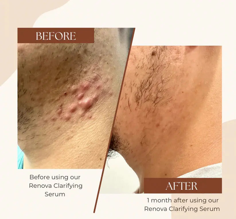 Evatasha | Clarifying Serum (For Acne Prone Skin) - Essentiallydestinyy